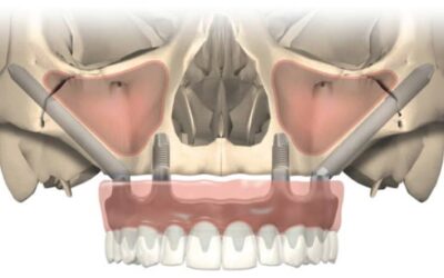 Denti fissi senza osso: la soluzione che cercavi!