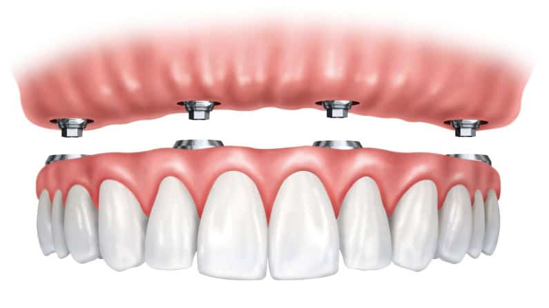 Arcata Dentale Completa